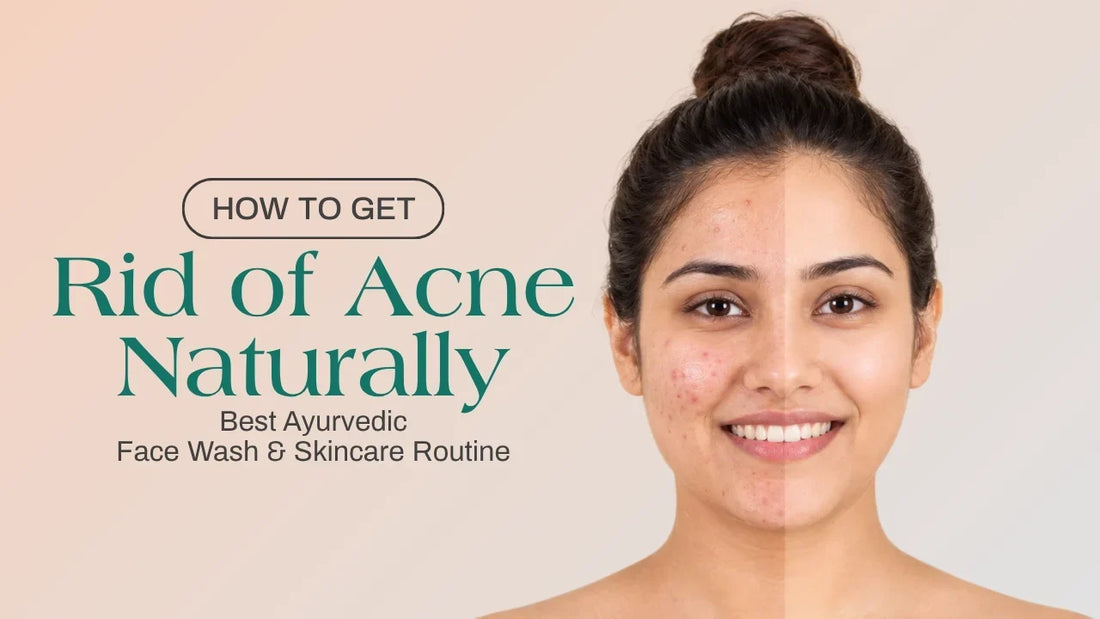 How to Get Rid of Acne Naturally: Best Ayurvedic Face Wash & Skincare Routine
