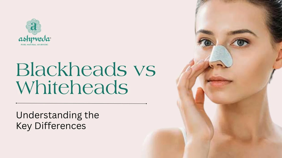 Blackheads and Whiteheads
