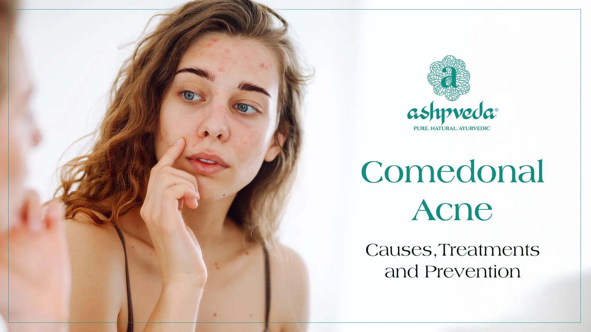 Comedonal Acne - Ashpveda