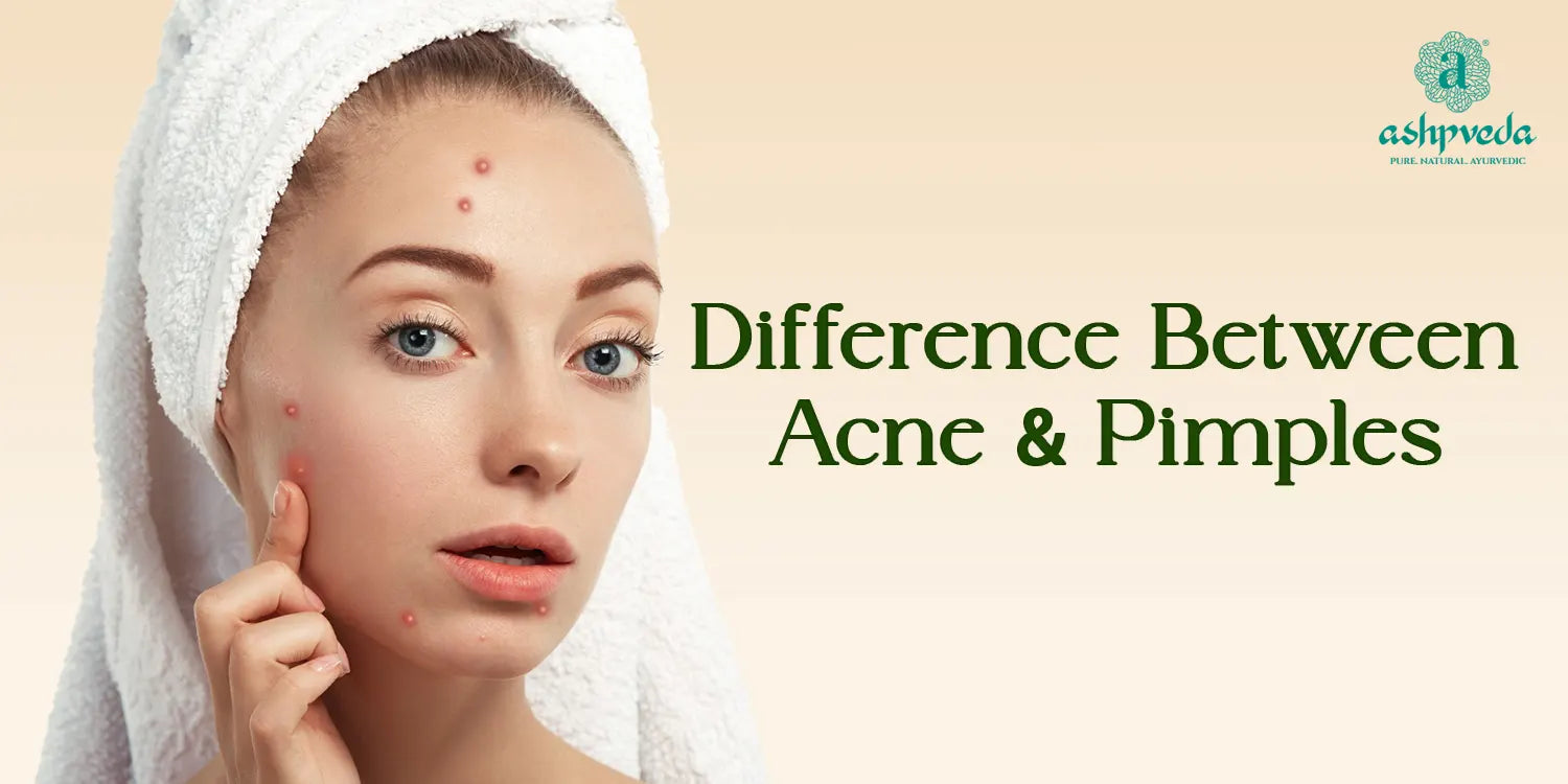 Difference Between Acne And Pimples - Ashpveda