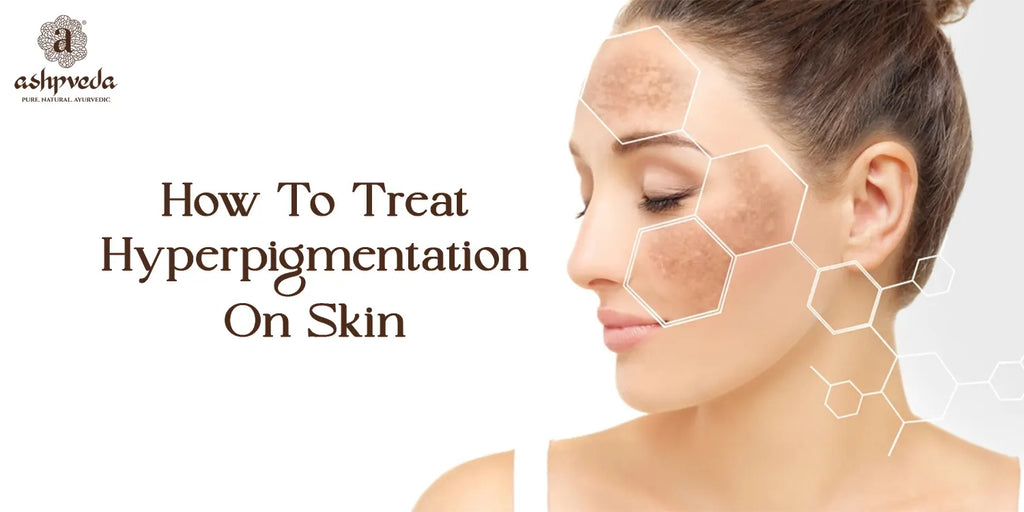 How To Treat Hyperpigmentation On Skin Naturally