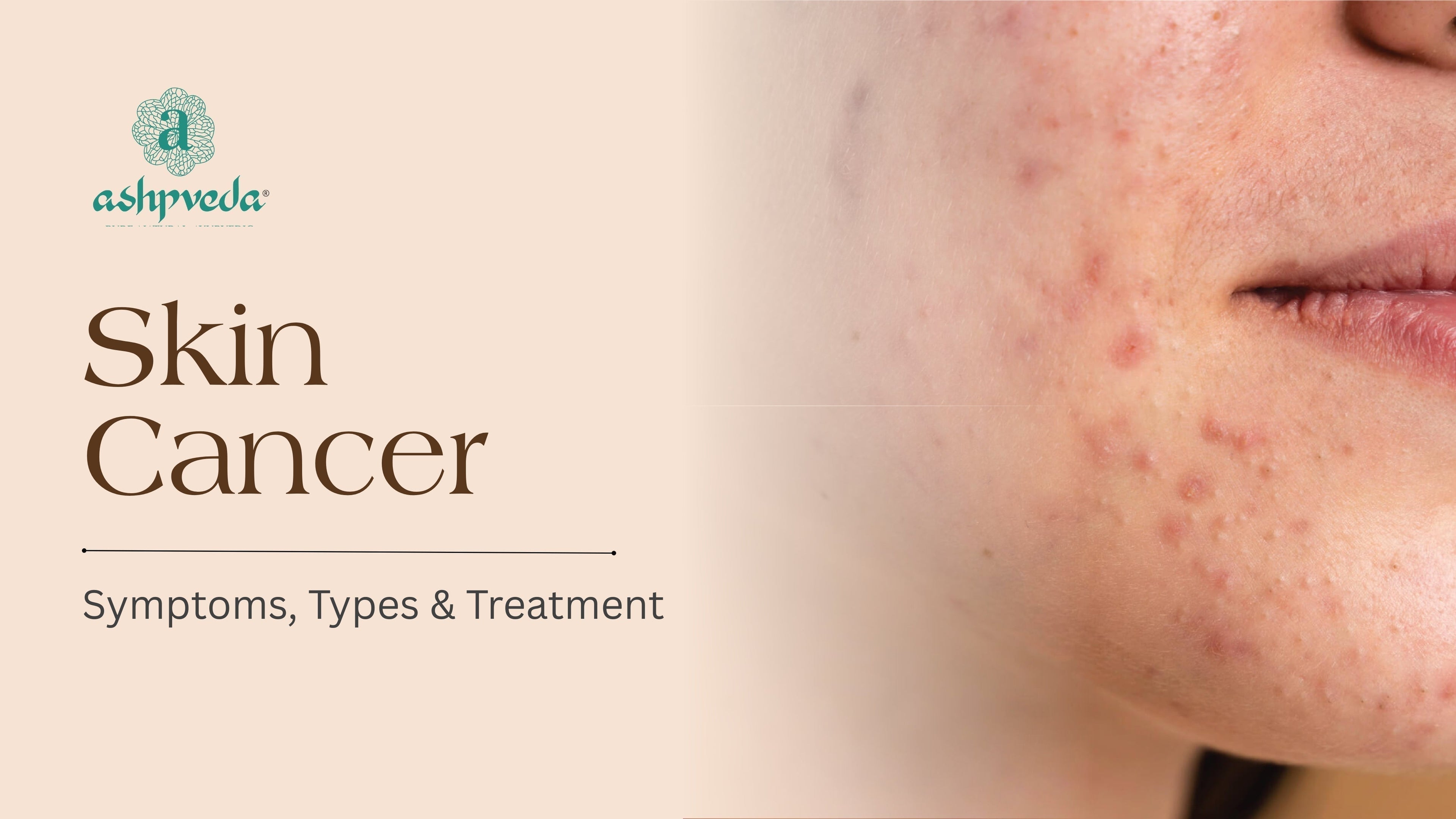 Most Skin Cancer Symptoms, Types and Treatment