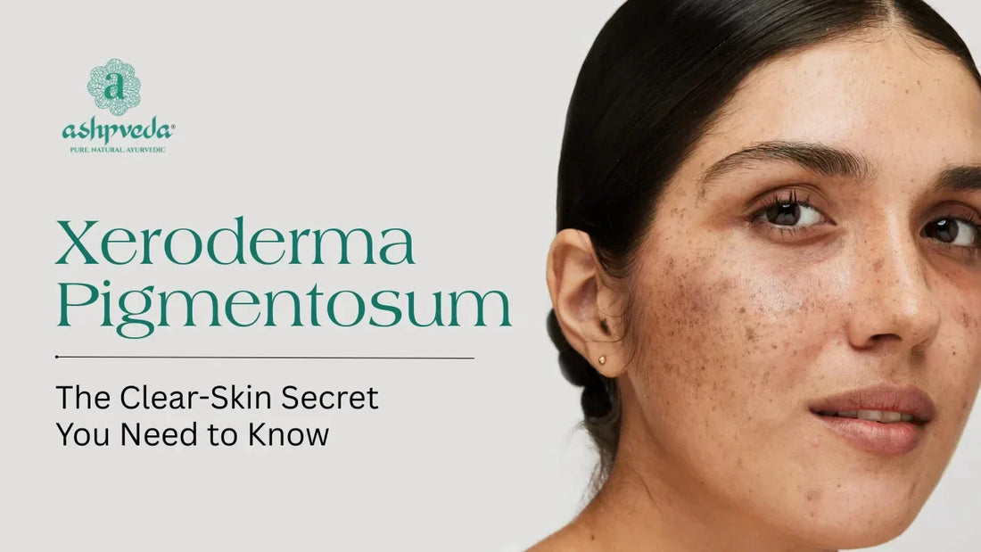 Xeroderma Pigmentosum – Symptoms, Causes, Treatment