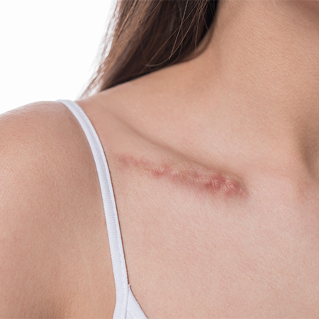 Body Scar