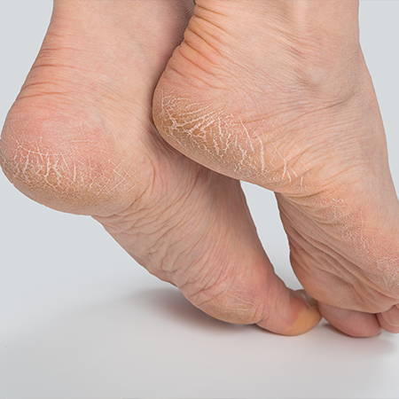Cracked Heel Repair
