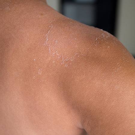 Body Dryness